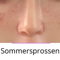 Sommersprossen